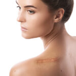 Zdjęcie przedstawiające profesjonalny zabieg redukcji blizn pooperacyjnych, mający na celu poprawę wyglądu skóry po operacjach.