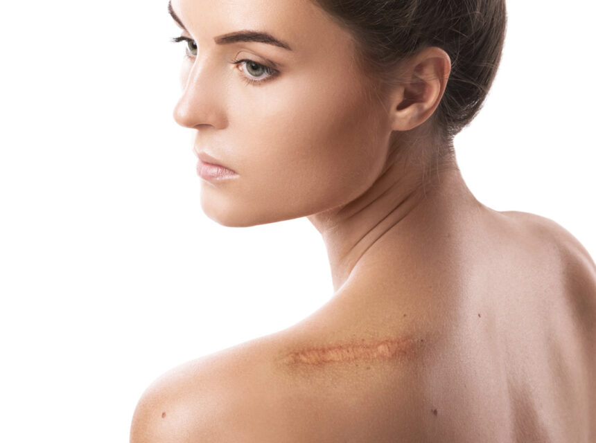 Zdjęcie przedstawiające profesjonalny zabieg redukcji blizn pooperacyjnych, mający na celu poprawę wyglądu skóry po operacjach.