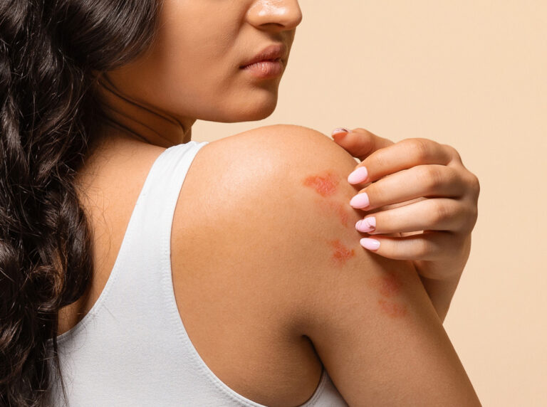 Fotografia przedstawia proces leczenia łuszczycy w gabinecie dermatologicznym. Dermatolog aplikuje specjalistyczny preparat na zmienione chorobowo miejsca na skórze pacjenta. Zdjęcie ukazuje sterylne warunki oraz nowoczesne metody terapeutyczne, takie jak fototerapia lub leczenie farmakologiczne.