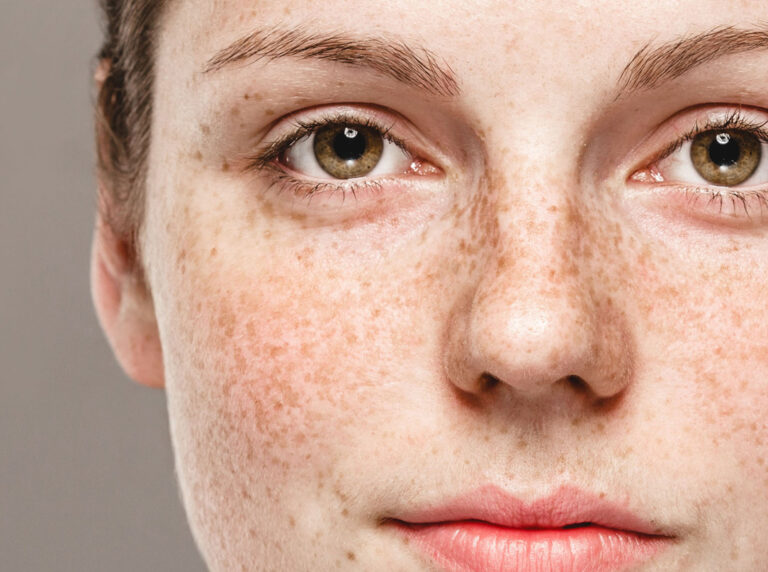 zabieg usuwania przebarwień skórnych przy użyciu nowoczesnego lasera dermatologicznego.