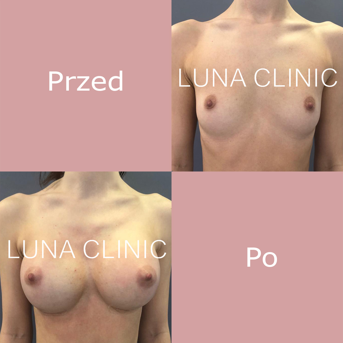 Powiększanie piersi