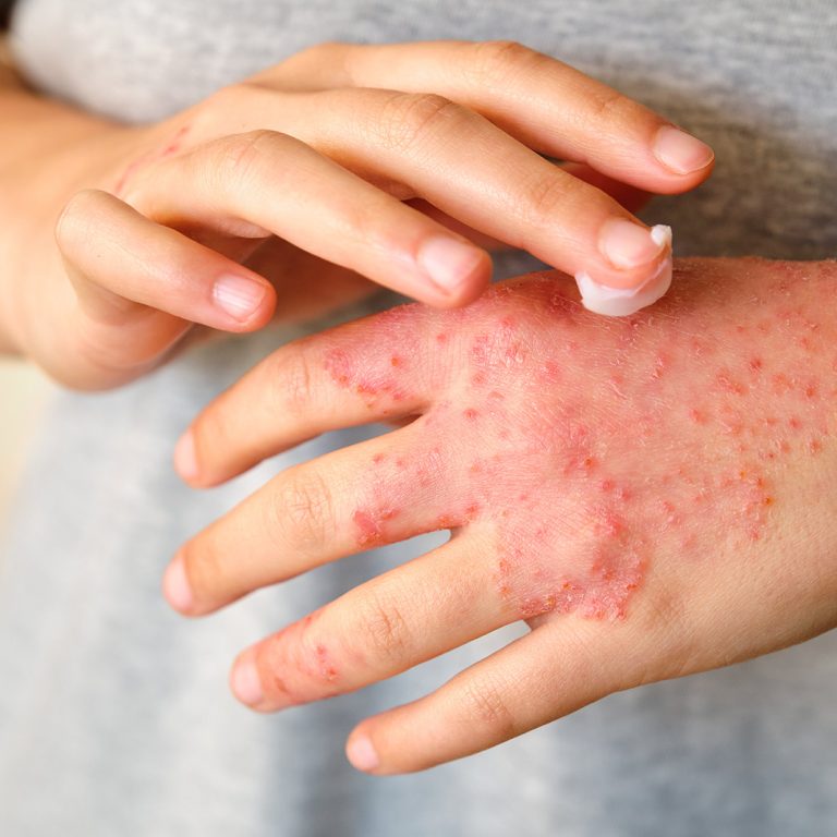 dermatologia-wroclaw-leczenie-atopowe-zapalenie-skory-1