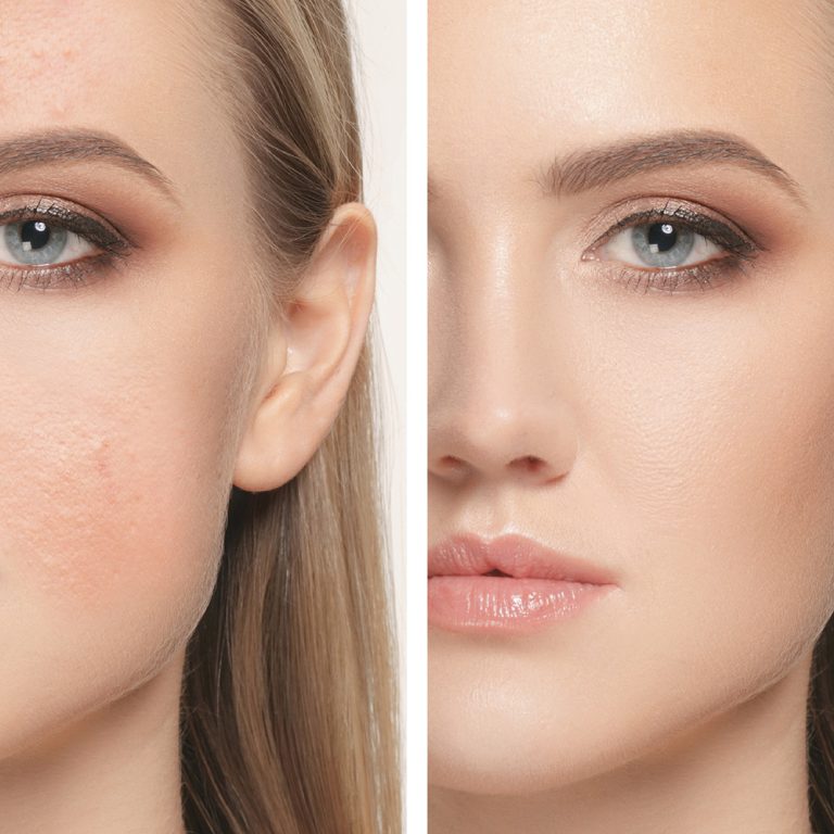 dermatologia-wroclaw-leczenie-popekanych-naczynek-1