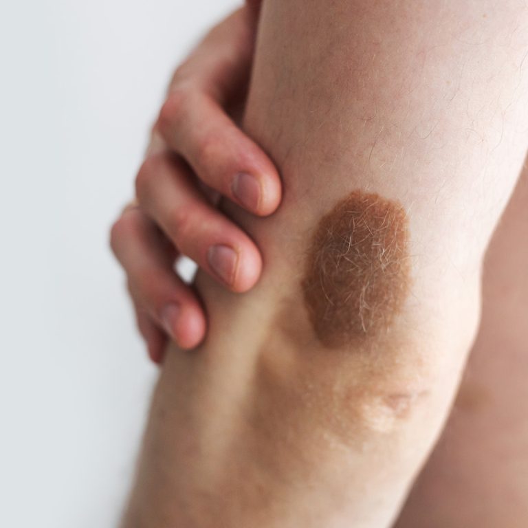 dermatologia-wroclaw--specjalistyczne-usuwanie-znamion-1