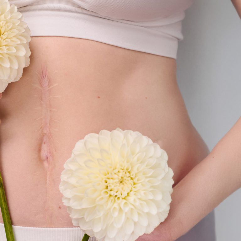 dermatologia-wroclaw-usuwanie-blizn-1