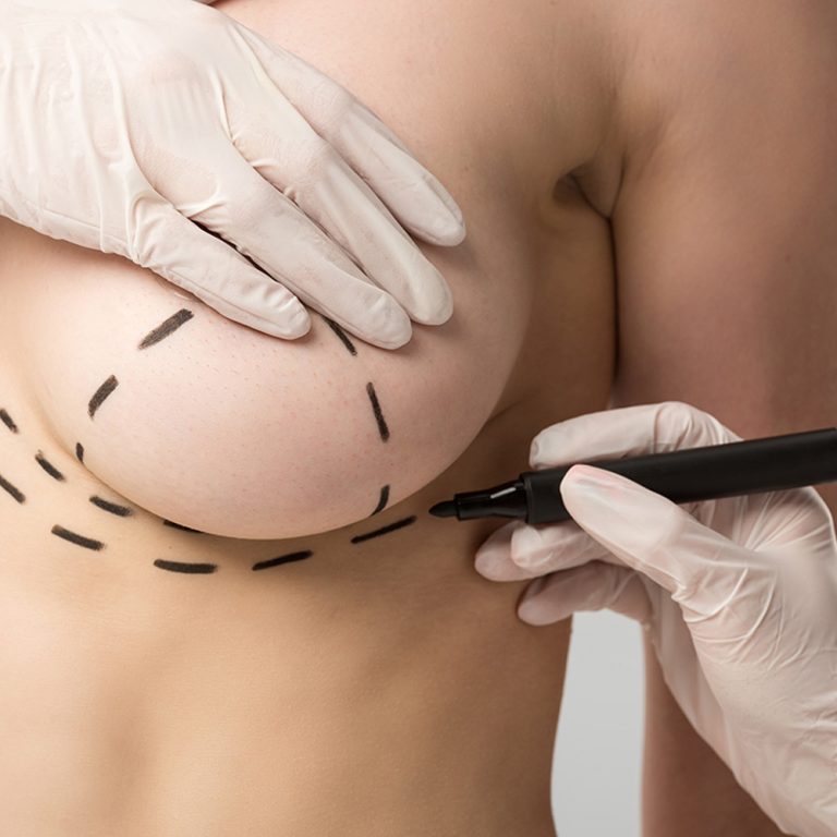 Nowoczesne implanty piersi – innowacje technologiczne zapewniające naturalny wygląd i większe bezpieczeństwo.