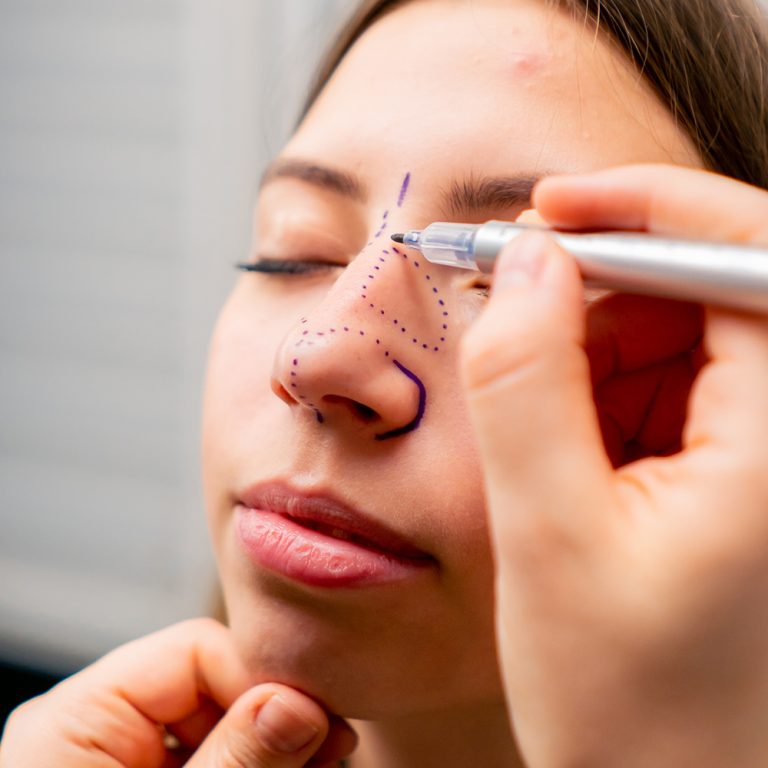 Plastyka nosa poprawiająca estetykę twarzy oraz funkcjonalność dróg oddechowych.