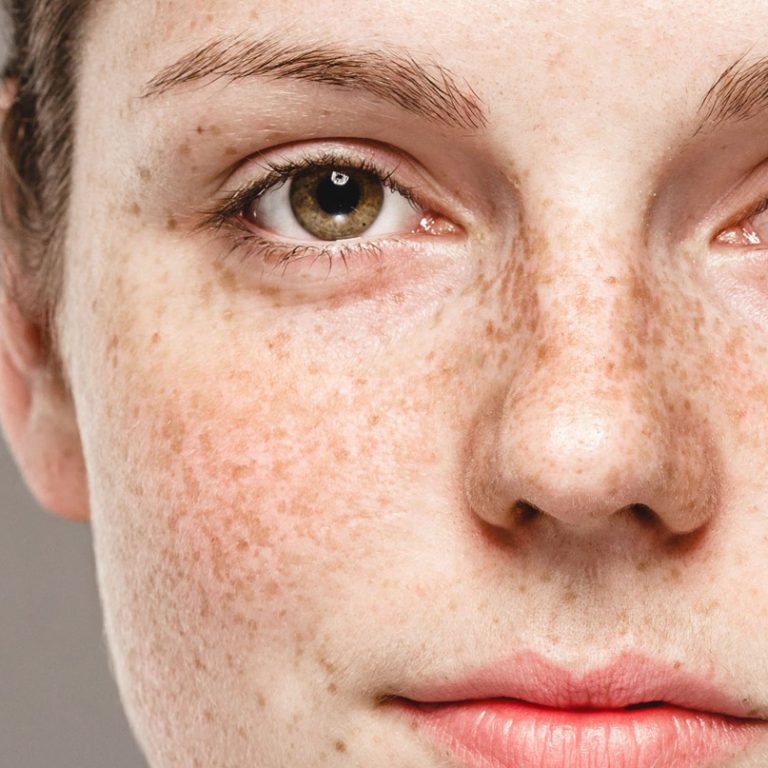 zabieg usuwania przebarwień skórnych przy użyciu nowoczesnego lasera dermatologicznego.